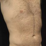 Liposuction Before & After Patient #726