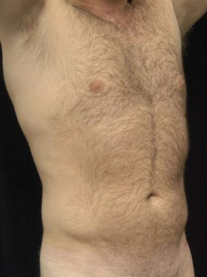 Liposuction Before & After Patient #726
