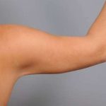 Liposuction Before & After Patient #731
