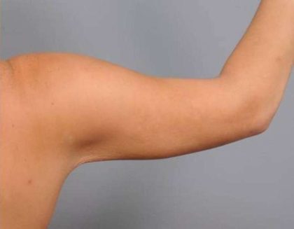 Liposuction Before & After Patient #731