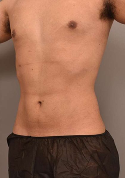 Liposuction Before & After Patient #749