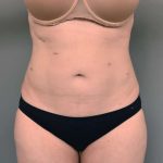 Liposuction Before & After Patient #756