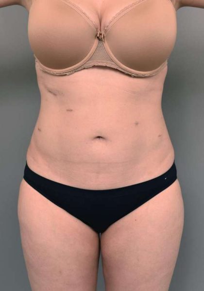 Liposuction Before & After Patient #756
