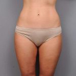 Liposuction Before & After Patient #761