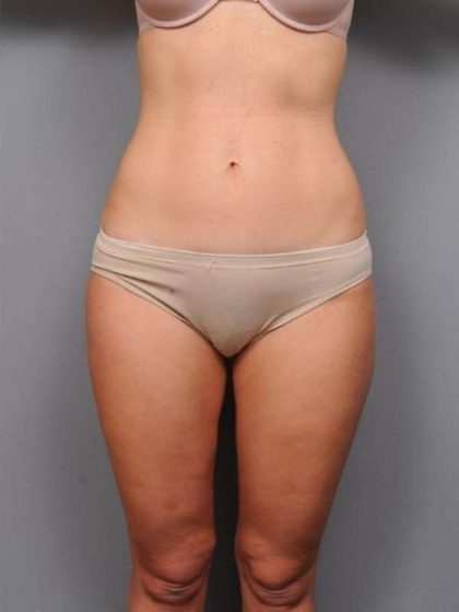 Liposuction Before & After Patient #761