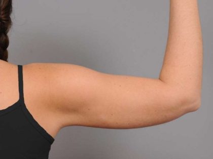 Liposuction Before & After Patient #768