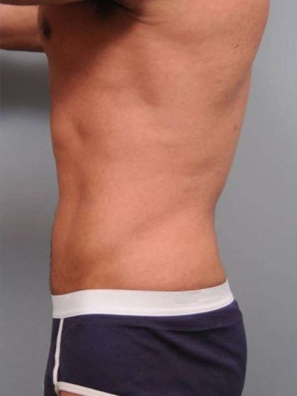 Liposuction Before & After Patient #783