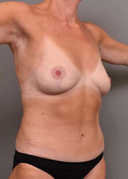 Tummy Tuck Before & After Patient #280