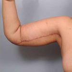Arm Lift Before & After Patient #790