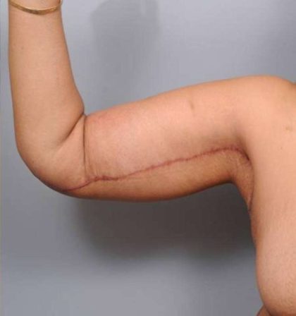 Arm Lift Before & After Patient #790
