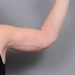 Arm Lift Before & After Patient #795