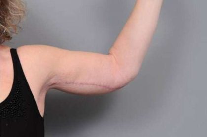 Arm Lift Before & After Patient #795