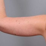 Arm Lift Before & After Patient #800