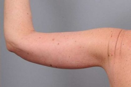 Arm Lift Before & After Patient #800