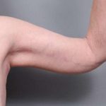 Arm Lift Before & After Patient #807
