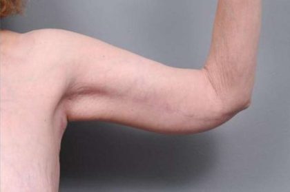 Arm Lift Before & After Patient #807
