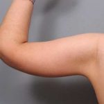 Arm Lift Before & After Patient #814