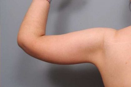Arm Lift Before & After Patient #814