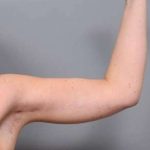 Arm Lift Before & After Patient #819