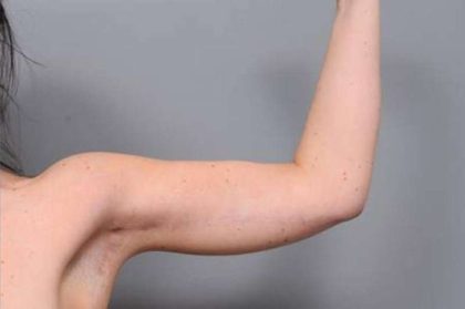 Arm Lift Before & After Patient #819