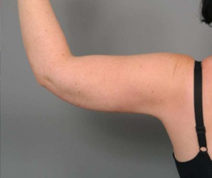 Arm Liposuction Before & After Patient #826