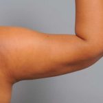 Arm Liposuction Before & After Patient #833