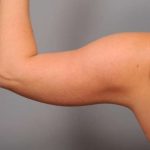 Arm Liposuction Before & After Patient #842