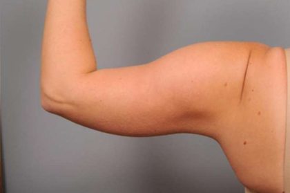 Arm Liposuction Before & After Patient #842