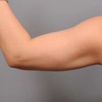 Arm Liposuction Before & After Patient #851