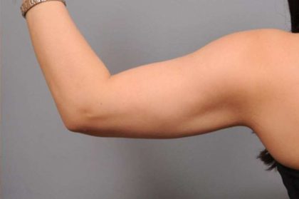 Arm Liposuction Before & After Patient #851