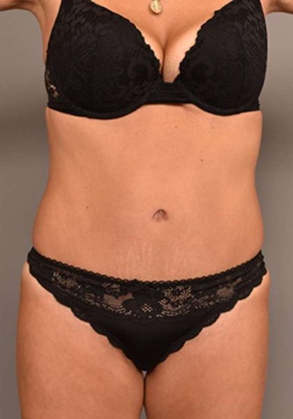 Tummy Tuck Before & After Patient #287