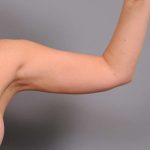 Arm Liposuction Before & After Patient #858