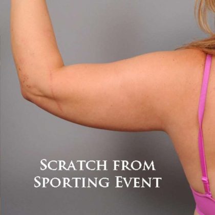 Arm Liposuction Before & After Patient #872