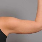 Arm Liposuction Before & After Patient #879