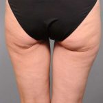 Thigh Lift Before & After Patient #896