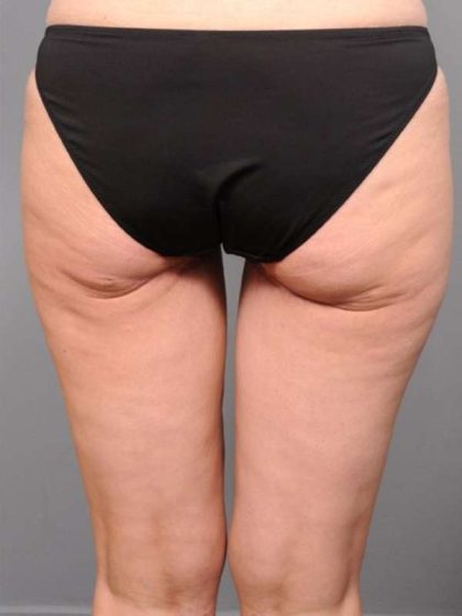 Thigh Lift Before & After Patient #896