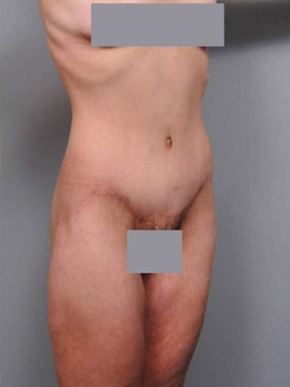 Lower Body Lift Before & After Patient #925