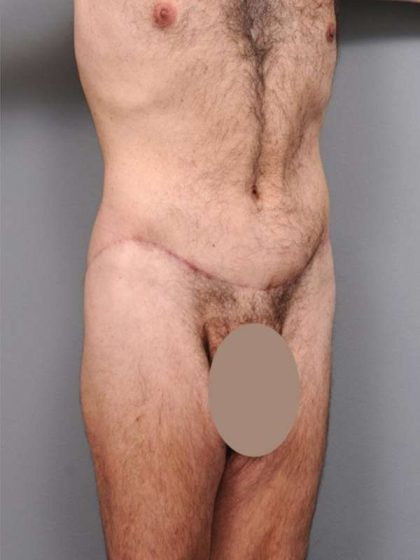 Lower Body Lift Before & After Patient #932