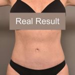 Tummy Tuck Before & After Patient #296