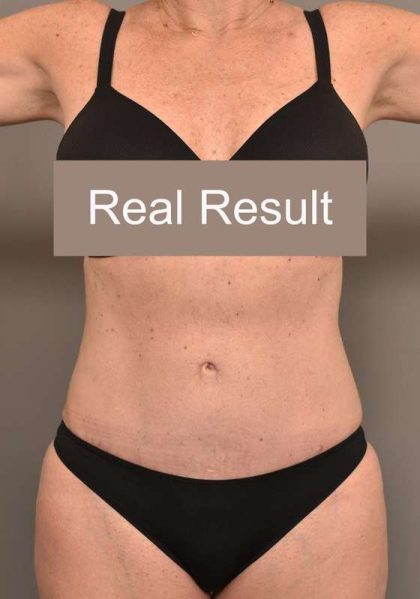 Tummy Tuck Before & After Patient #296