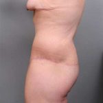 Lower Body Lift Before & After Patient #985