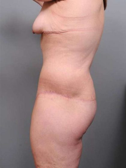 Lower Body Lift Before & After Patient #985