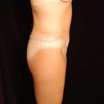 Lower Body Lift Before & After Patient #999
