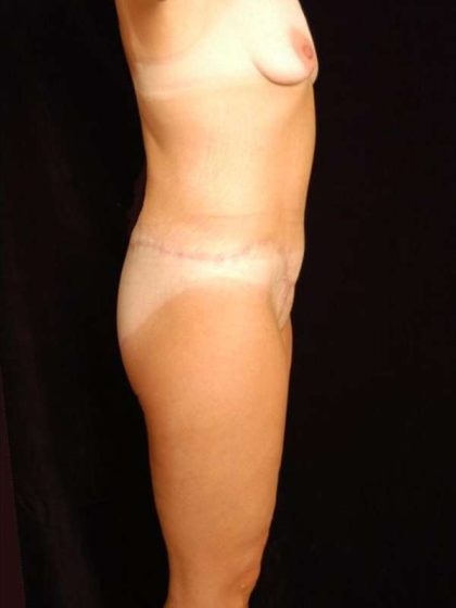 Lower Body Lift Before & After Patient #999