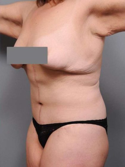 Lower Body Lift Before & After Patient #1027
