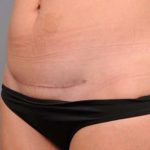 Scar Revision Before & After Patient #1041