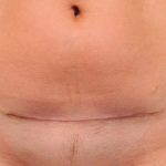 Scar Revision Before & After Patient #1071