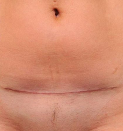 Scar Revision Before & After Patient #1071