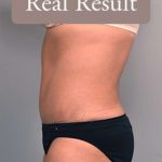 Tummy Tuck Before & After Patient #303