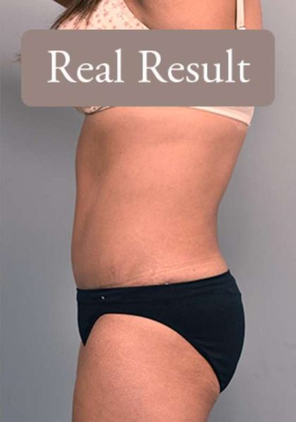 Tummy Tuck Before & After Patient #303